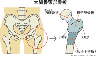 大腿骨頸部骨折