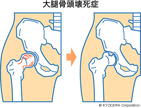 大腿骨頭壊死症