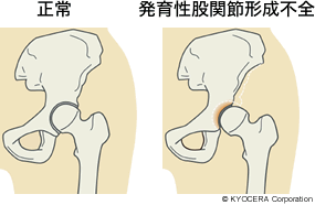 正常、発育性股関節形成不全