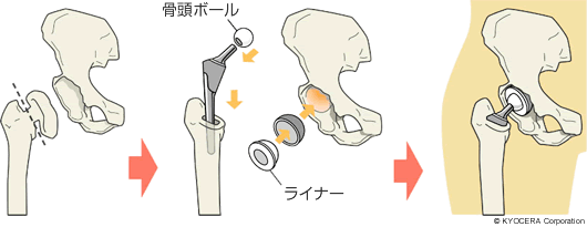 全人工股関節置換術（THA）