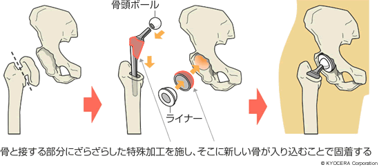 骨と接する部分にざらざらした特殊加工を施し、そこに新しい骨が入り込むことで固着する