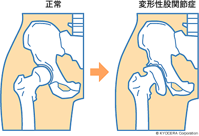 正常、変形性股関節症