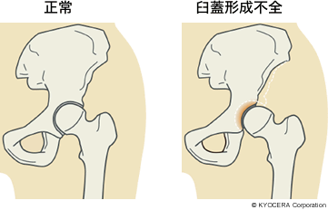 蓋 形成 不全 難病 臼