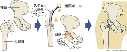 人工股関節　イラスト