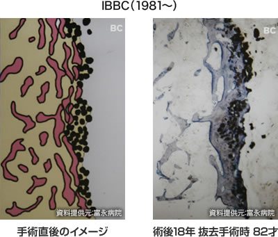 IBBC（1981～）手術直後のイメージ、術後18年 抜去手術時 82才