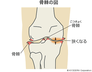 骨棘の図