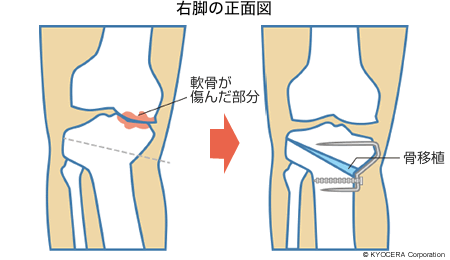 右脚の正面図