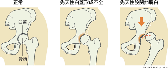 正常、先天性臼蓋形成不全、先天性股関節脱臼