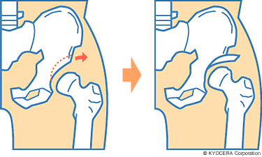 寛骨臼回転骨切り術