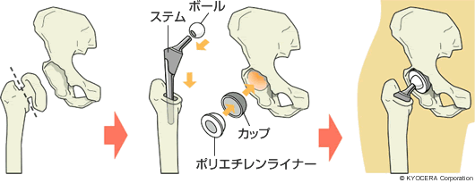 人工股関節全置換術