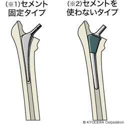 （※1）セメント固定タイプ、（※2）セメントを使わないタイプ