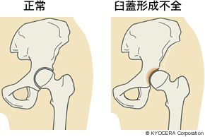 正常、臼蓋形成不全