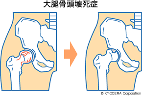 大腿骨頭壊死症