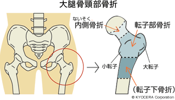 大腿骨頸部骨折