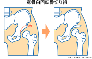 寛骨臼回転骨切り術