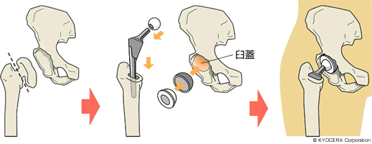 人工股関節全置換術（Total Hip Arthroplasty：THA)