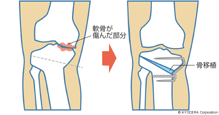 骨切り術の例