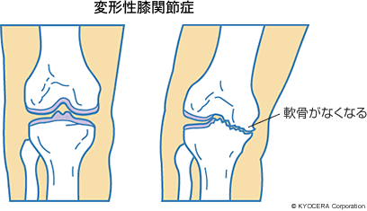 変形性膝関節症