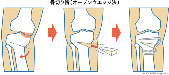 骨切り術（オープンウエッジ法）