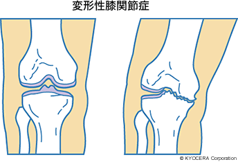 変形性膝関節症