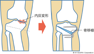 高位脛骨骨切り術