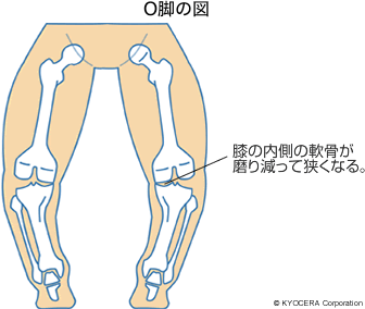 O脚の図