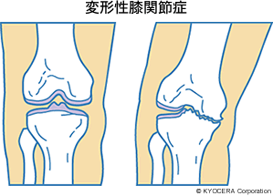 変形性膝関節症