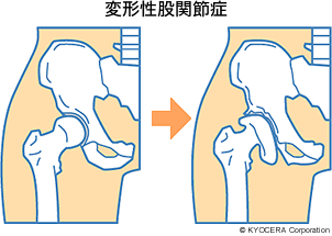 変形性股関節症