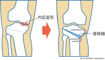 高位脛骨骨切り術