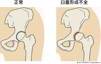 正常、臼蓋形成不全