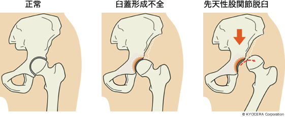 正常 臼蓋形成不全 先天性股関節脱臼