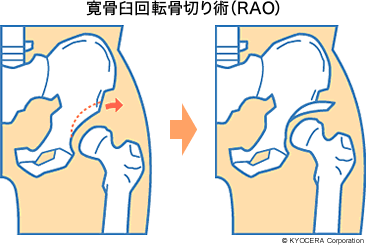 股関節 臼 蓋 形成 不全