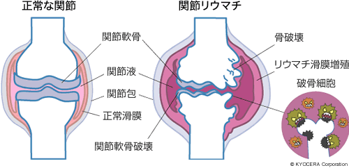 正常な関節、関節リウマチ