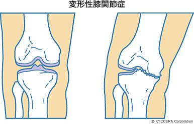 変形性膝関節症