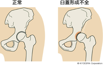 正常、臼蓋形成不全