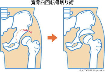 寛骨臼回転骨切り術