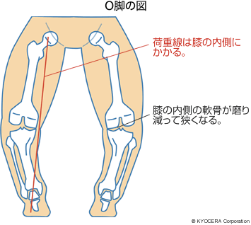 O脚の図