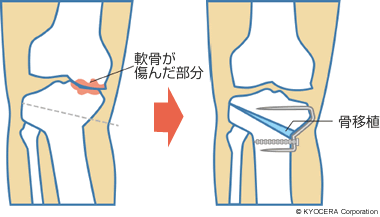 高位脛骨骨切り術（右脚の正面図）