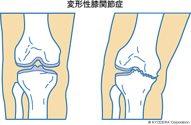 変形性膝関節症