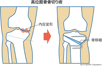 高位脛骨骨切り術