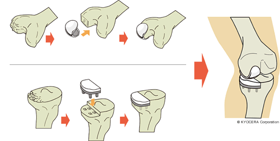 人工膝関節単顆置換術