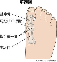 強剛母趾 中島 健一郎 強剛母趾の治療では 独自にやり方を考案した手術もあります その治療法はきっとまだまだ進化することでしょう