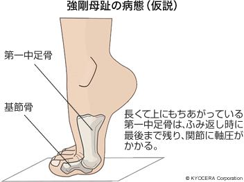 強剛母趾の病態（仮説）