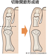 切除関節形成術