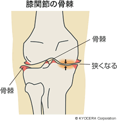 膝関節の骨棘