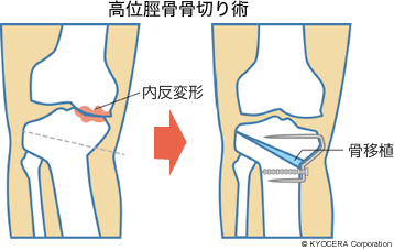 高位脛骨骨切り術