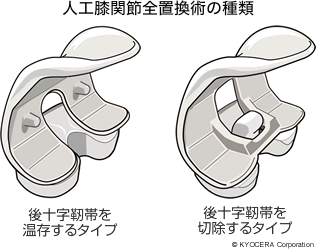 人工膝関節全置換術の種類