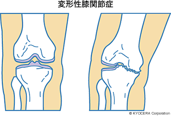 変形性膝関節症