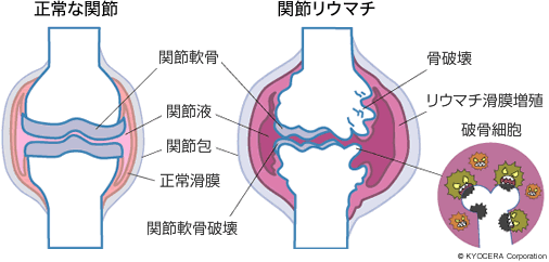 正常な関節 関節リウマチ