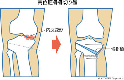 高位脛骨骨切り術